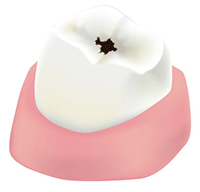 C1…エナメル質のむし歯(歯の表面) C1…エナメル質のむし歯(歯の表面)